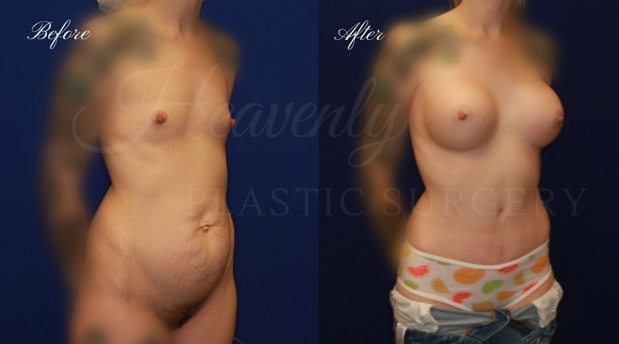 Mommy makeover before and after, mommy makeover surgery, breast lift surgery, tummy tuck surgery, breast lift before and after, tummy tuck before and after, mommy makeover surgeon, mommy makeover surgery, mommy makeover orange county, tummy tuck orange county, breast lift orange county, plastic surgery, plastic surgeon, plastic surgery before and after, mommy makeover journey, mommy makeover results, tummy tuck journey, tummy tuck results, plastic surgery results, orange county plastic surgeon, orange county plastic surgery, plastic surgery orange county Mommy makeover before and after, mommy makeover surgery, breast lift surgery, tummy tuck surgery, breast lift before and after, tummy tuck before and after, mommy makeover surgeon, mommy makeover surgery, mommy makeover orange county, tummy tuck orange county, breast lift orange county, plastic surgery, plastic surgeon, plastic surgery before and after, mommy makeover journey, mommy makeover results, tummy tuck journey, tummy tuck results, plastic surgery results, orange county plastic surgeon, orange county plastic surgery, plastic surgery orange county