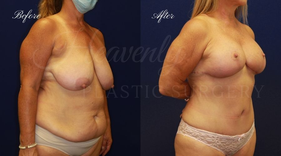 Mommy makeover before and after, mommy makeover surgery, breast lift surgery, tummy tuck surgery, breast lift before and after, tummy tuck before and after, mommy makeover surgeon, mommy makeover surgery, mommy makeover orange county, tummy tuck orange county, breast lift orange county, plastic surgery, plastic surgeon, plastic surgery before and after, mommy makeover journey, mommy makeover results, tummy tuck journey, tummy tuck results, plastic surgery results, orange county plastic surgeon, orange county plastic surgery, plastic surgery orange county Mommy makeover before and after, mommy makeover surgery, breast lift surgery, tummy tuck surgery, breast lift before and after, tummy tuck before and after, mommy makeover surgeon, mommy makeover surgery, mommy makeover orange county, tummy tuck orange county, breast lift orange county, plastic surgery, plastic surgeon, plastic surgery before and after, mommy makeover journey, mommy makeover results, tummy tuck journey, tummy tuck results, plastic surgery results, orange county plastic surgeon, orange county plastic surgery, plastic surgery orange county