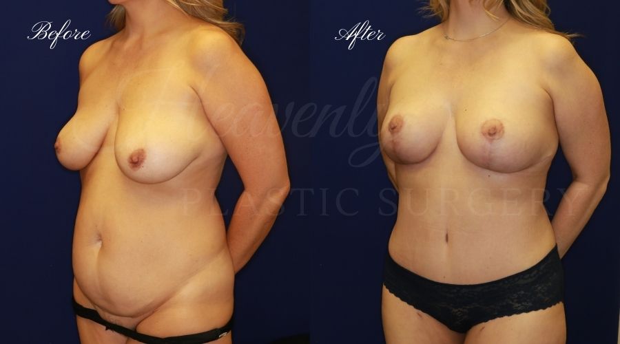 Mommy makeover before and after, mommy makeover surgery, breast augmentation surgery, tummy tuck surgery, breast augmentation before and after, tummy tuck before and after, mommy makeover surgeon, mommy makeover surgery, mommy makeover orange county, tummy tuck orange county, breast augmentationorange county, plastic surgery, plastic surgeon, plastic surgery before and after, mommy makeover journey, mommy makeover results, tummy tuck journey, tummy tuck results, plastic surgery results, orange county plastic surgeon, orange county plastic surgery, plastic surgery orange county, breast implants, breast implants orange county Mommy makeover before and after, mommy makeover surgery, breast augmentation surgery, tummy tuck surgery, breast augmentation before and after, tummy tuck before and after, mommy makeover surgeon, mommy makeover surgery, mommy makeover orange county, tummy tuck orange county, breast augmentationorange county, plastic surgery, plastic surgeon, plastic surgery before and after, mommy makeover journey, mommy makeover results, tummy tuck journey, tummy tuck results, plastic surgery results, orange county plastic surgeon, orange county plastic surgery, plastic surgery orange county, breast implants, breast implants orange county