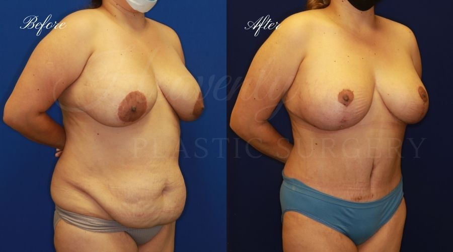 Mommy makeover before and after, mommy makeover surgery, breast lift surgery, tummy tuck surgery, breast lift before and after, tummy tuck before and after, mommy makeover surgeon, mommy makeover surgery, mommy makeover orange county, tummy tuck orange county, breast lift orange county, plastic surgery, plastic surgeon, plastic surgery before and after, mommy makeover journey, mommy makeover results, tummy tuck journey, tummy tuck results, plastic surgery results, orange county plastic surgeon, orange county plastic surgery, plastic surgery orange county Mommy makeover before and after, mommy makeover surgery, breast lift surgery, tummy tuck surgery, breast lift before and after, tummy tuck before and after, mommy makeover surgeon, mommy makeover surgery, mommy makeover orange county, tummy tuck orange county, breast lift orange county, plastic surgery, plastic surgeon, plastic surgery before and after, mommy makeover journey, mommy makeover results, tummy tuck journey, tummy tuck results, plastic surgery results, orange county plastic surgeon, orange county plastic surgery, plastic surgery orange county