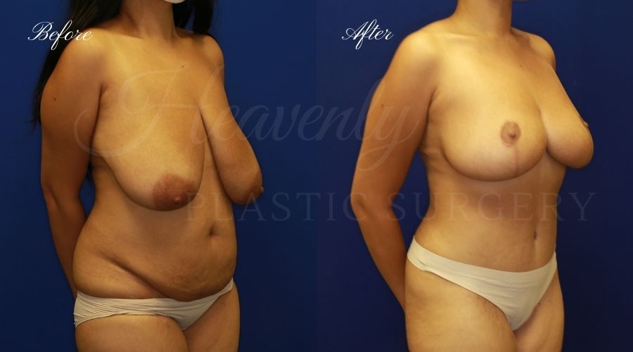 Mommy makeover before and after, mommy makeover surgery, breast lift surgery, tummy tuck surgery, breast lift before and after, tummy tuck before and after, mommy makeover surgeon, mommy makeover surgery, mommy makeover orange county, tummy tuck orange county, breast lift orange county, plastic surgery, plastic surgeon, plastic surgery before and after, mommy makeover journey, mommy makeover results, tummy tuck journey, tummy tuck results, plastic surgery results, orange county plastic surgeon, orange county plastic surgery, plastic surgery orange county Mommy makeover before and after, mommy makeover surgery, breast lift surgery, tummy tuck surgery, breast lift before and after, tummy tuck before and after, mommy makeover surgeon, mommy makeover surgery, mommy makeover orange county, tummy tuck orange county, breast lift orange county, plastic surgery, plastic surgeon, plastic surgery before and after, mommy makeover journey, mommy makeover results, tummy tuck journey, tummy tuck results, plastic surgery results, orange county plastic surgeon, orange county plastic surgery, plastic surgery orange county