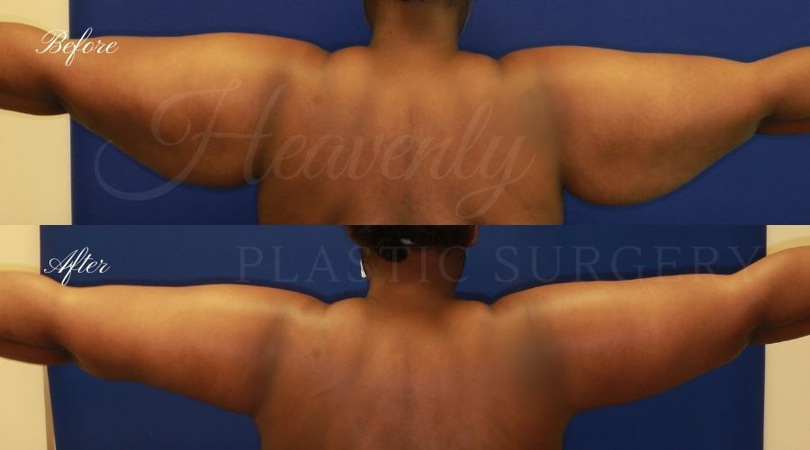 Mommy makeover before and after, breast lift before and after, arm lift before and after, breast reduction before and after, breast lift surgeon, mommy makeover surgeon, arm lift surgeon, plastic surgery, plastic surgeon, breast plastic surgery, arm plastic surgery, mommy makeover orange county, arm lift orange county, breast lift orange county, plastic surgeon orange county Mommy makeover before and after, breast lift before and after, arm lift before and after, breast reduction before and after, breast lift surgeon, mommy makeover surgeon, arm lift surgeon, plastic surgery, plastic surgeon, breast plastic surgery, arm plastic surgery, mommy makeover orange county, arm lift orange county, breast lift orange county, plastic surgeon orange county