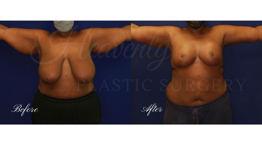 Mommy Makeover - Breast Lift + Arm Lift - Front TIAL Mommy makeover before and after, breast lift before and after, arm lift before and after, breast reduction before and after, breast lift surgeon, mommy makeover surgeon, arm lift surgeon, plastic surgery, plastic surgeon, breast plastic surgery, arm plastic surgery, mommy makeover orange county, arm lift orange county, breast lift orange county, plastic surgeon orange county