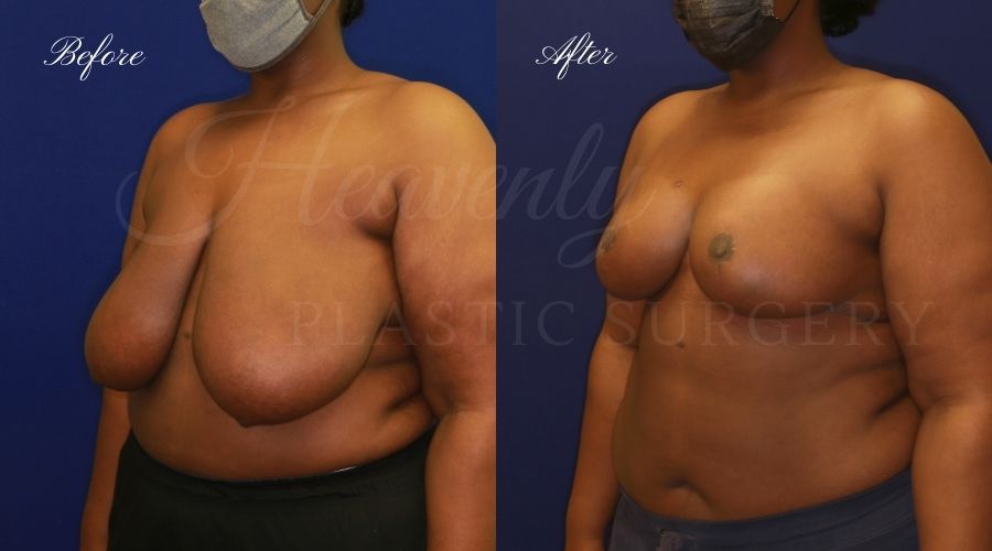 Mommy makeover before and after, breast lift before and after, arm lift before and after, breast reduction before and after, breast lift surgeon, mommy makeover surgeon, arm lift surgeon, plastic surgery, plastic surgeon, breast plastic surgery, arm plastic surgery, mommy makeover orange county, arm lift orange county, breast lift orange county, plastic surgeon orange county