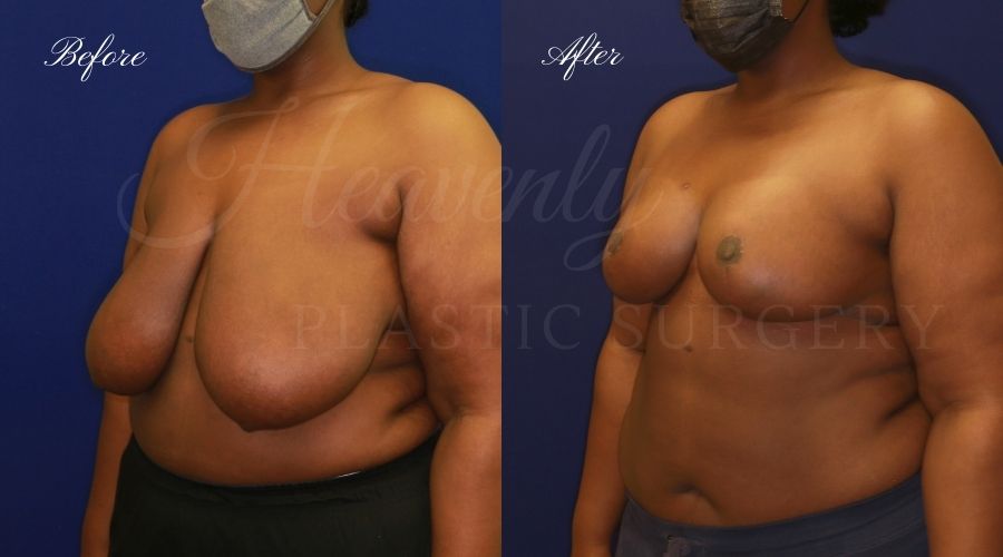 Mommy makeover before and after, breast lift before and after, arm lift before and after, breast reduction before and after, breast lift surgeon, mommy makeover surgeon, arm lift surgeon, plastic surgery, plastic surgeon, breast plastic surgery, arm plastic surgery, mommy makeover orange county, arm lift orange county, breast lift orange county, plastic surgeon orange county Mommy makeover before and after, breast lift before and after, arm lift before and after, breast reduction before and after, breast lift surgeon, mommy makeover surgeon, arm lift surgeon, plastic surgery, plastic surgeon, breast plastic surgery, arm plastic surgery, mommy makeover orange county, arm lift orange county, breast lift orange county, plastic surgeon orange county