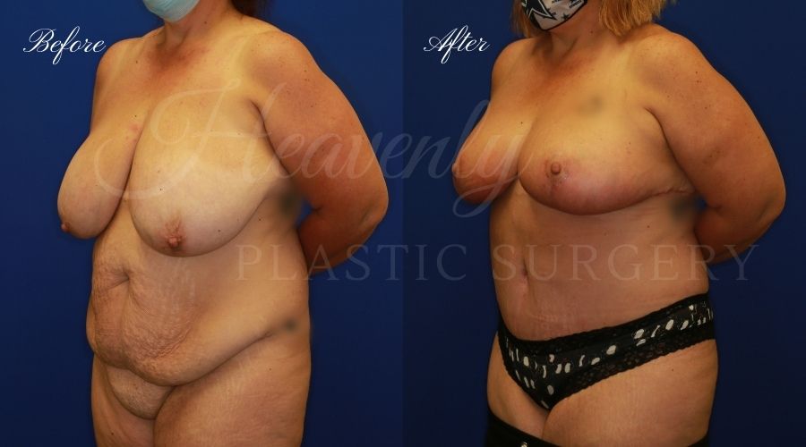 Mommy makeover before and after, mommy makeover surgery, breast augmentation surgery, tummy tuck surgery, breast augmentation before and after, tummy tuck before and after, mommy makeover surgeon, mommy makeover surgery, mommy makeover orange county, tummy tuck orange county, breast augmentationorange county, plastic surgery, plastic surgeon, plastic surgery before and after, mommy makeover journey, mommy makeover results, tummy tuck journey, tummy tuck results, plastic surgery results, orange county plastic surgeon, orange county plastic surgery, plastic surgery orange county, breast implants, breast implants orange county Mommy makeover before and after, mommy makeover surgery, breast augmentation surgery, tummy tuck surgery, breast augmentation before and after, tummy tuck before and after, mommy makeover surgeon, mommy makeover surgery, mommy makeover orange county, tummy tuck orange county, breast augmentationorange county, plastic surgery, plastic surgeon, plastic surgery before and after, mommy makeover journey, mommy makeover results, tummy tuck journey, tummy tuck results, plastic surgery results, orange county plastic surgeon, orange county plastic surgery, plastic surgery orange county, breast implants, breast implants orange county