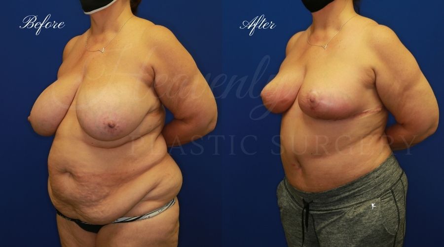 Mommy makeover before and after, mommy makeover surgery, breast augmentation surgery, tummy tuck surgery, breast augmentation before and after, tummy tuck before and after, mommy makeover surgeon, mommy makeover surgery, mommy makeover orange county, tummy tuck orange county, breast augmentationorange county, plastic surgery, plastic surgeon, plastic surgery before and after, mommy makeover journey, mommy makeover results, tummy tuck journey, tummy tuck results, plastic surgery results, orange county plastic surgeon, orange county plastic surgery, plastic surgery orange county, breast implants, breast implants orange county Mommy makeover before and after, mommy makeover surgery, breast augmentation surgery, tummy tuck surgery, breast augmentation before and after, tummy tuck before and after, mommy makeover surgeon, mommy makeover surgery, mommy makeover orange county, tummy tuck orange county, breast augmentationorange county, plastic surgery, plastic surgeon, plastic surgery before and after, mommy makeover journey, mommy makeover results, tummy tuck journey, tummy tuck results, plastic surgery results, orange county plastic surgeon, orange county plastic surgery, plastic surgery orange county, breast implants, breast implants orange county