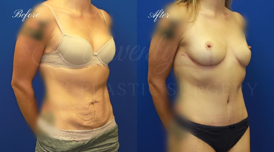Mommy makeover before and after, mommy makeover surgery, breast augmentation surgery, tummy tuck surgery, breast augmentation before and after, tummy tuck before and after, mommy makeover surgeon, mommy makeover surgery, mommy makeover orange county, tummy tuck orange county, breast augmentationorange county, plastic surgery, plastic surgeon, plastic surgery before and after, mommy makeover journey, mommy makeover results, tummy tuck journey, tummy tuck results, plastic surgery results, orange county plastic surgeon, orange county plastic surgery, plastic surgery orange county, breast implants, breast implants orange county Mommy makeover before and after, mommy makeover surgery, breast augmentation surgery, tummy tuck surgery, breast augmentation before and after, tummy tuck before and after, mommy makeover surgeon, mommy makeover surgery, mommy makeover orange county, tummy tuck orange county, breast augmentationorange county, plastic surgery, plastic surgeon, plastic surgery before and after, mommy makeover journey, mommy makeover results, tummy tuck journey, tummy tuck results, plastic surgery results, orange county plastic surgeon, orange county plastic surgery, plastic surgery orange county, breast implants, breast implants orange county