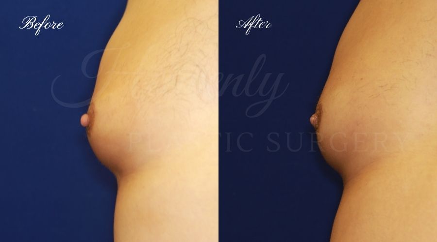 nipple reduction, nipple reduction surgery, nipple reduction surgeon, nipple surgery, plastic surgery, plastic surgeon, nipple reduction orange county, nipple surgery orange county, orange county plastic surgeon, orange county plastic surgery, male nipple reduction nipple reduction, nipple reduction surgery, nipple reduction surgeon, nipple surgery, plastic surgery, plastic surgeon, nipple reduction orange county, nipple surgery orange county, orange county plastic surgeon, orange county plastic surgery, male nipple reduction