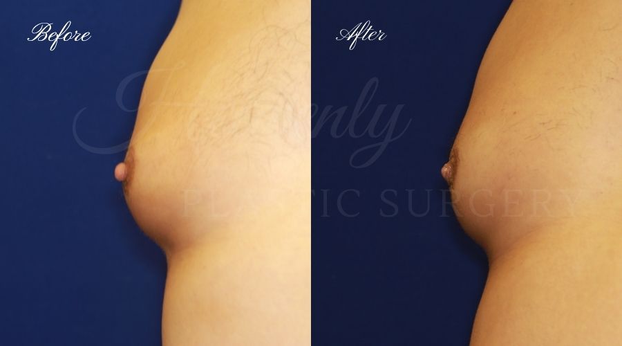 nipple reduction, nipple reduction surgery, nipple reduction surgeon, nipple surgery, plastic surgery, plastic surgeon, nipple reduction orange county, nipple surgery orange county, orange county plastic surgeon, orange county plastic surgery, male nipple reduction