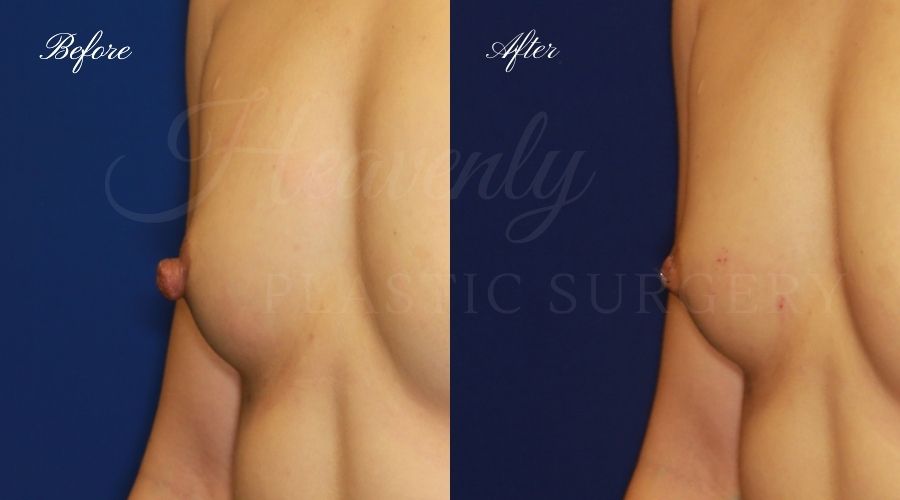 nipple reduction, nipple reduction surgery, nipple reduction surgeon, nipple surgery, plastic surgery, plastic surgeon, nipple reduction orange county, nipple surgery orange county, orange county plastic surgeon, orange county plastic surgery