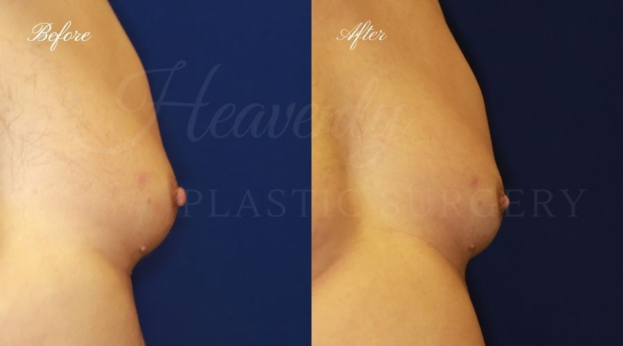 nipple reduction, nipple reduction surgery, nipple reduction surgeon, nipple surgery, plastic surgery, plastic surgeon, nipple reduction orange county, nipple surgery orange county, orange county plastic surgeon, orange county plastic surgery nipple reduction, nipple reduction surgery, nipple reduction surgeon, nipple surgery, plastic surgery, plastic surgeon, nipple reduction orange county, nipple surgery orange county, orange county plastic surgeon, orange county plastic surgery