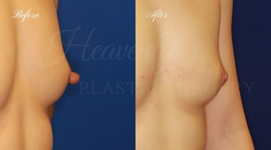Nipple Reduction - Right Oblique PALE nipple reduction, nipple reduction surgery, nipple reduction surgeon, nipple surgery, plastic surgery, plastic surgeon, nipple reduction orange county, nipple surgery orange county, orange county plastic surgeon, orange county plastic surgery