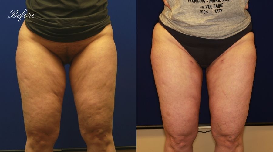 Thigh Liposuction Before and After - Front WEKO Thigh Liposuction Before and After - Front WEKO