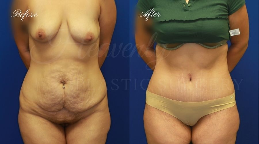 Plastic Surgery, Plastic Surgeon, Tummy Tuck, Abdominoplasty, Tummy Tuck with Lipo, Liposuction, Orange County Plastic Surgeon, Orange County Plastic Surgery, Fupa, Fupa surgery, fupa surgeon