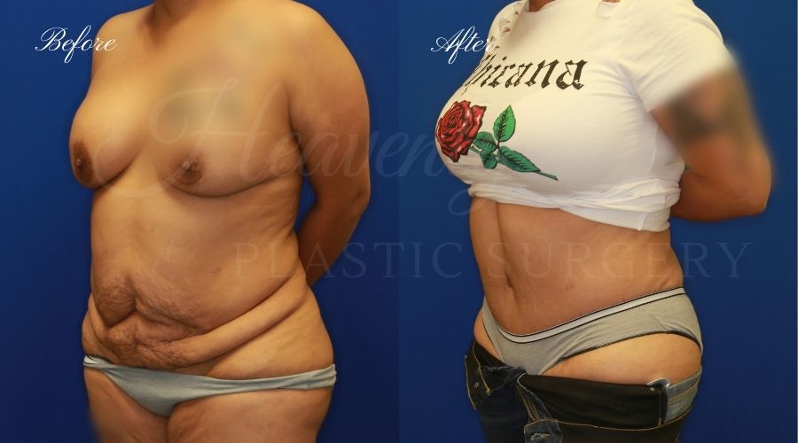 Plastic Surgery, Plastic Surgeon, Tummy Tuck, Abdominoplasty, Tummy Tuck with Lipo, Liposuction, Orange County Plastic Surgeon, Orange County Plastic Surgery, Fupa, Fupa surgery, fupa surgeon