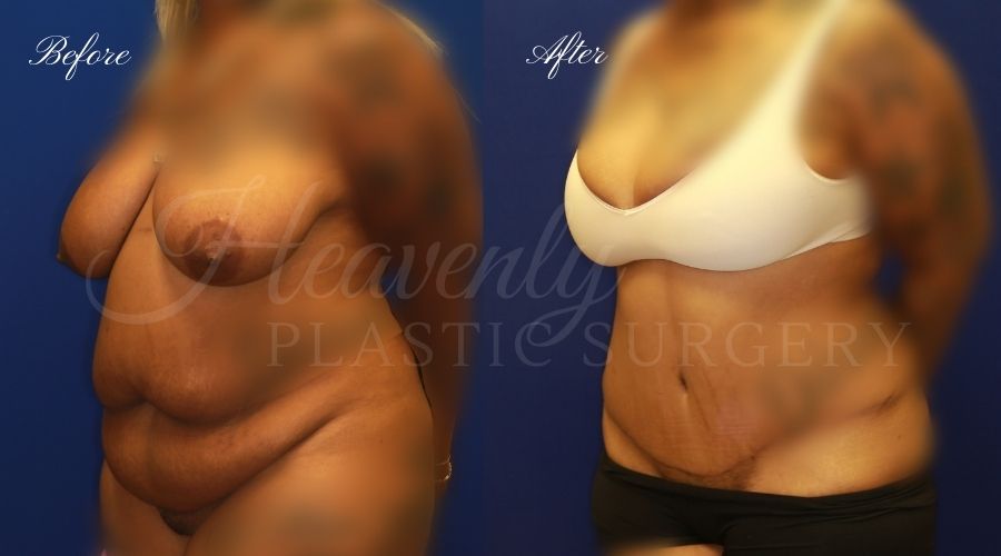 Plastic Surgery, Plastic Surgeon, Tummy Tuck, Abdominoplasty, Tummy Tuck with Lipo, Liposuction, Orange County Plastic Surgeon, Orange County Plastic Surgery, Fupa, Fupa surgery, fupa surgeon