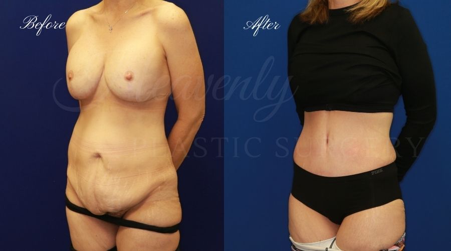 Plastic Surgery, Plastic Surgeon, Tummy Tuck, Abdominoplasty, Tummy Tuck with Lipo, Liposuction, Orange County Plastic Surgeon, Orange County Plastic Surgery, Fupa, Fupa surgery, fupa surgeon