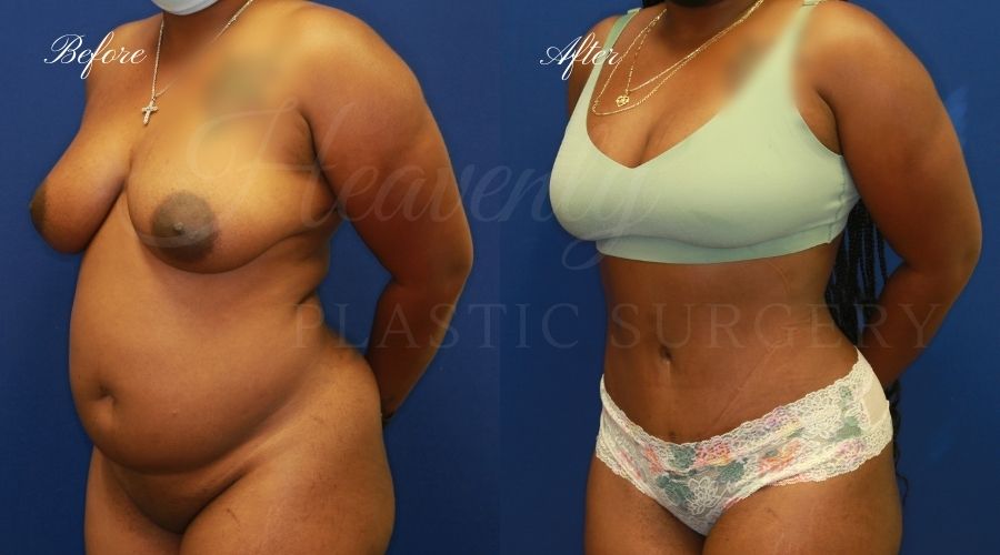 Tummy Tuck Gallery - Heavenly Plastic Surgery