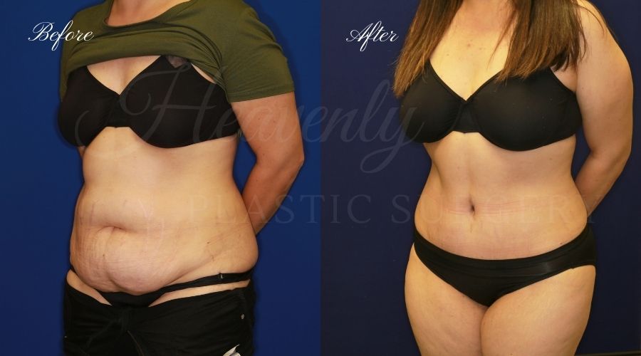 Plastic Surgery, Plastic Surgeon, Tummy Tuck, Abdominoplasty, Tummy Tuck with Lipo, Liposuction, Orange County Plastic Surgeon, Orange County Plastic Surgery, Fupa, Fupa surgery, fupa surgeon