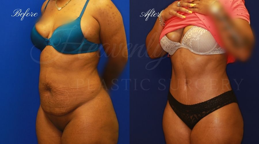 Tummy Tuck Gallery - Heavenly Plastic Surgery