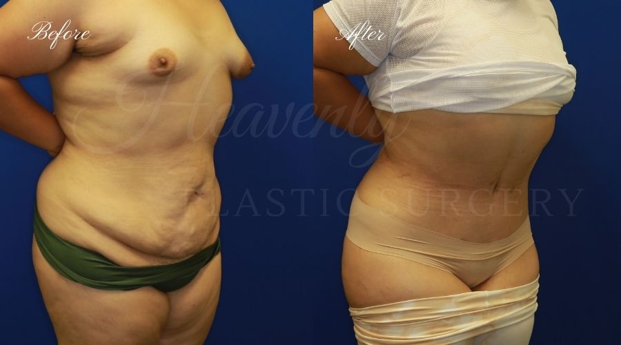 Plastic Surgery, Plastic Surgeon, Tummy Tuck, Abdominoplasty, Tummy Tuck with Lipo, Liposuction, Orange County Plastic Surgeon, Orange County Plastic Surgery, Fupa, Fupa surgery, fupa surgeon