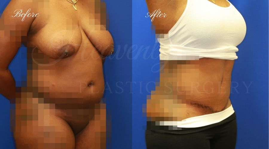 Plastic Surgery, Plastic Surgeon, Tummy Tuck, Abdominoplasty, Tummy Tuck with Lipo, Liposuction, Orange County Plastic Surgeon, Orange County Plastic Surgery, Fupa, Fupa surgery, fupa surgeon