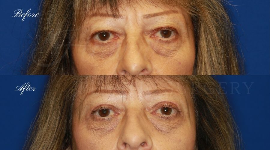 Plastic surgeon, plastic surgery, upper blepharoplasty, eyelid surgery, lower blepharoplasty, droopy eyelids Plastic surgeon, plastic surgery, upper blepharoplasty, eyelid surgery, lower blepharoplasty, droopy eyelids