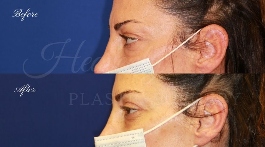 Plastic surgeon, plastic surgery, upper blepharoplasty, eyelid surgery, lower blepharoplasty, droopy eyelids