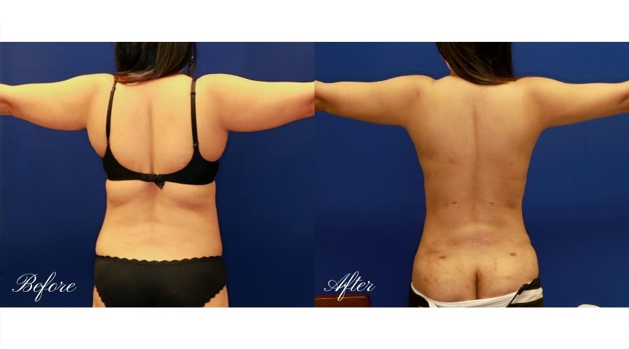 Liposculpture and Liposuction Before and After