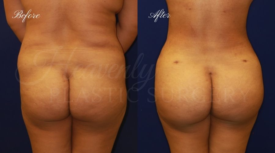 BBL Orange county, brazilian butt lift orange county, brazilian butt lift before and after, brazilian butt lift surgeon, brazilian butt lift results, bbl surgeon, bbl results, bbl before and after, fat transfer to the butt, butt augmentation, butt augmentation surgery, butt augmentation surgeon BBL Orange county, brazilian butt lift orange county, brazilian butt lift before and after, brazilian butt lift surgeon, brazilian butt lift results, bbl surgeon, bbl results, bbl before and after, fat transfer to the butt, butt augmentation, butt augmentation surgery, butt augmentation surgeon