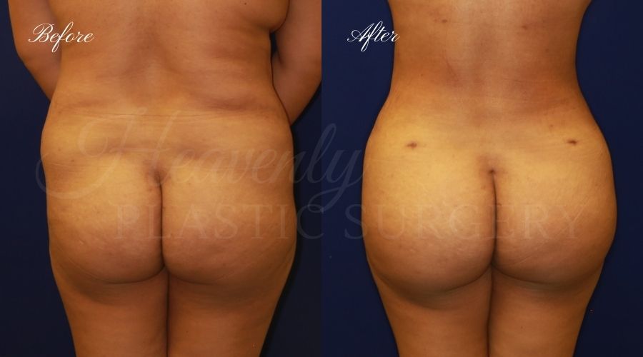 BBL Orange county, brazilian butt lift orange county, brazilian butt lift before and after, brazilian butt lift surgeon, brazilian butt lift results, bbl surgeon, bbl results, bbl before and after, fat transfer to the butt, butt augmentation, butt augmentation surgery, butt augmentation surgeon