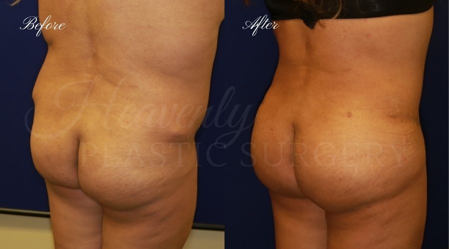 BBL Orange county, brazilian butt lift orange county, brazilian butt lift before and after, brazilian butt lift surgeon, brazilian butt lift results, bbl surgeon, bbl results, bbl before and after, fat transfer to the butt, butt augmentation, butt augmentation surgery, butt augmentation surgeon