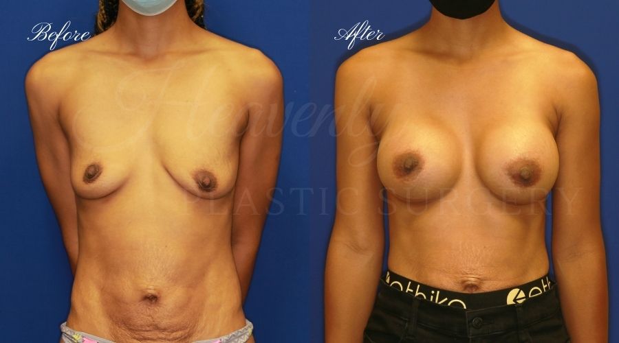 breast augmentation, breast augmentation surgery, breast augmentation surgeon, breast augmentation orange county, breast augmentation with silicone implants, sientra implants, boob job, boob job surgeon, breast implant surgeon, plastic surgery orange county, lake forest plastic surgeon, breast augmentation lake forest, south oc plastic surgeon