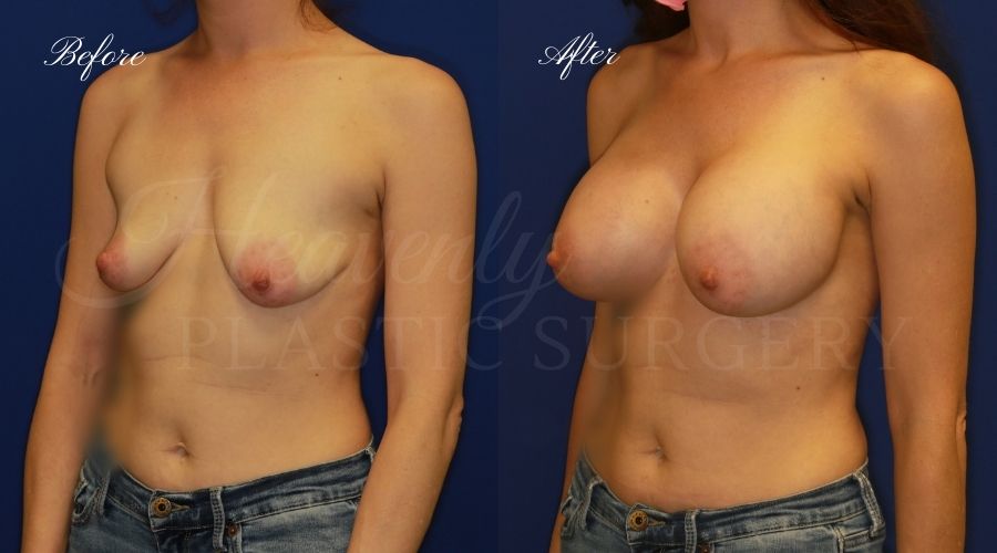 breast augmentation, breast augmentation surgery, breast augmentation surgeon, breast augmentation orange county, breast augmentation with silicone implants, sientra implants, boob job, boob job surgeon, breast implant surgeon, plastic surgery orange county, lake forest plastic surgeon, breast augmentation lake forest, south oc plastic surgeon