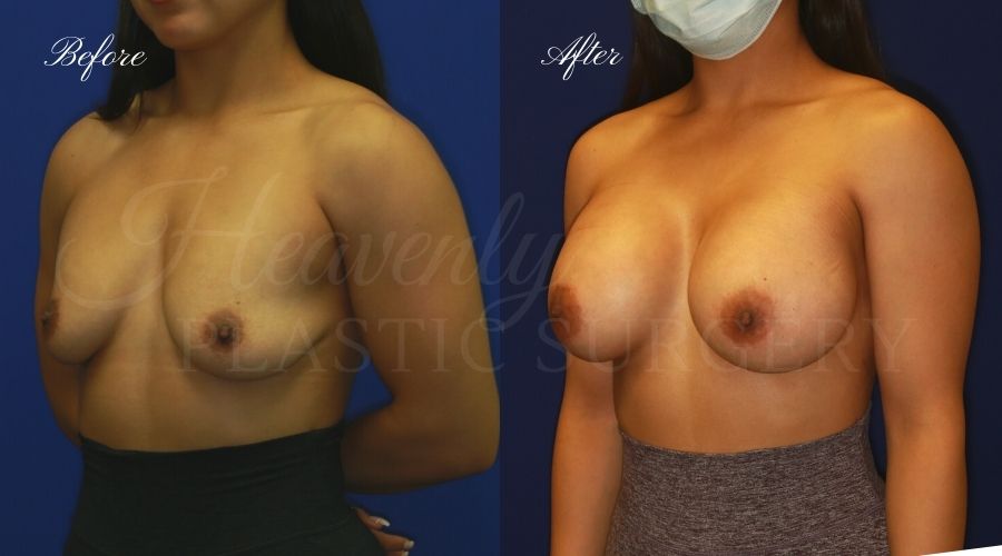 breast augmentation, breast augmentation surgery, breast augmentation surgeon, breast augmentation orange county, breast augmentation with silicone implants, sientra implants, boob job, boob job surgeon, breast implant surgeon, plastic surgery orange county, lake forest plastic surgeon, breast augmentation lake forest, south oc plastic surgeonBreast Augmentation Before & After- Left Oblique- CHSI breast augmentation, breast augmentation surgery, breast augmentation surgeon, breast augmentation orange county, breast augmentation with silicone implants, sientra implants, boob job, boob job surgeon, breast implant surgeon, plastic surgery orange county, lake forest plastic surgeon, breast augmentation lake forest, south oc plastic surgeon