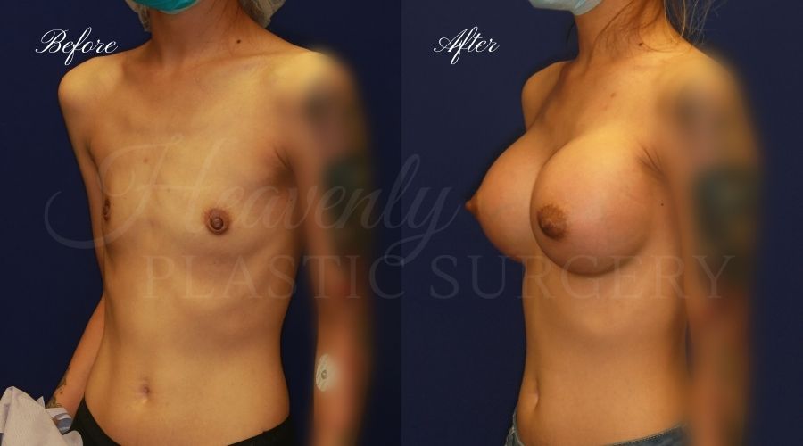 breast augmentation, breast augmentation surgery, breast augmentation surgeon, breast augmentation orange county, breast augmentation with silicone implants, sientra implants, boob job, boob job surgeon, breast implant surgeon, plastic surgery orange county, lake forest plastic surgeon, breast augmentation lake forest, south oc plastic surgeon