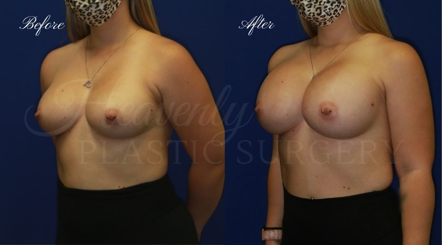 breast augmentation, breast augmentation surgery, breast augmentation surgeon, breast augmentation orange county, breast augmentation with silicone implants, sientra implants, boob job, boob job surgeon, breast implant surgeon, plastic surgery orange county, lake forest plastic surgeon, breast augmentation lake forest, south oc plastic surgeon