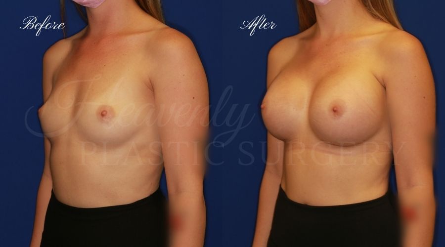 breast augmentation, breast augmentation surgery, breast augmentation surgeon, breast augmentation orange county, breast augmentation with silicone implants, sientra implants, boob job, boob job surgeon, breast implant surgeon, plastic surgery orange county, lake forest plastic surgeon, breast augmentation lake forest, south oc plastic surgeon breast augmentation, breast augmentation surgery, breast augmentation surgeon, breast augmentation orange county, breast augmentation with silicone implants, sientra implants, boob job, boob job surgeon, breast implant surgeon, plastic surgery orange county, lake forest plastic surgeon, breast augmentation lake forest, south oc plastic surgeon