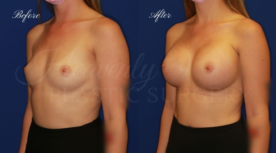 breast augmentation, breast augmentation surgery, breast augmentation surgeon, breast augmentation orange county, breast augmentation with silicone implants, sientra implants, boob job, boob job surgeon, breast implant surgeon, plastic surgery orange county, lake forest plastic surgeon, breast augmentation lake forest, south oc plastic surgeon