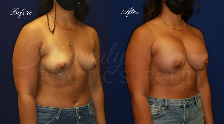 breast augmentation, breast augmentation surgery, breast augmentation surgeon, breast augmentation orange county, breast augmentation with silicone implants, sientra implants, boob job, boob job surgeon, breast implant surgeon, plastic surgery orange county, lake forest plastic surgeon, breast augmentation lake forest, south oc plastic surgeon