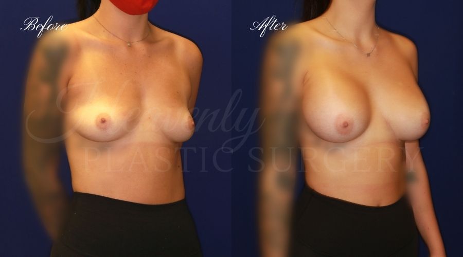 breast augmentation, breast augmentation surgery, breast augmentation surgeon, breast augmentation orange county, breast augmentation with silicone implants, sientra implants, boob job, boob job surgeon, breast implant surgeon, plastic surgery orange county, lake forest plastic surgeon, breast augmentation lake forest, south oc plastic surgeon