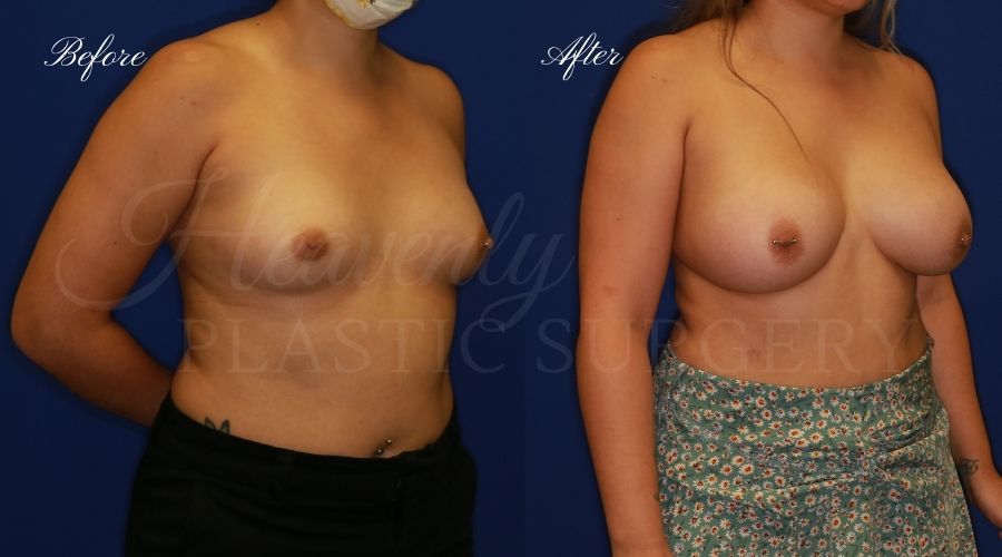 breast augmentation, breast augmentation surgery, breast augmentation surgeon, breast augmentation orange county, breast augmentation with silicone implants, sientra implants, boob job, boob job surgeon, breast implant surgeon, plastic surgery orange county, lake forest plastic surgeon, breast augmentation lake forest, south oc plastic surgeon