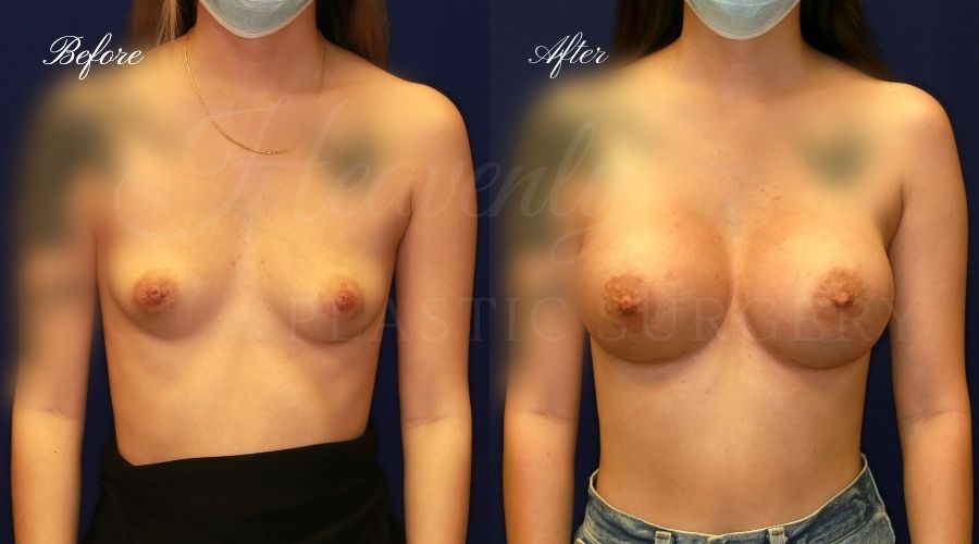 breast augmentation, breast augmentation surgery, breast augmentation surgeon, breast augmentation orange county, breast augmentation with silicone implants, sientra implants, boob job, boob job surgeon, breast implant surgeon, plastic surgery orange county, lake forest plastic surgeon, breast augmentation lake forest, south oc plastic surgeon