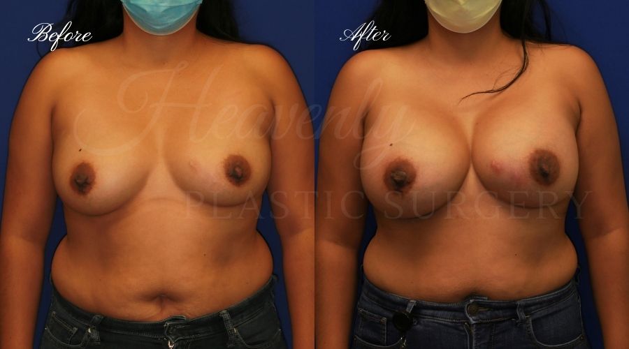 breast augmentation, breast augmentation surgery, breast augmentation surgeon, breast augmentation orange county, breast augmentation with silicone implants, sientra implants, boob job, boob job surgeon, breast implant surgeon, plastic surgery orange county, lake forest plastic surgeon, breast augmentation lake forest, south oc plastic surgeon