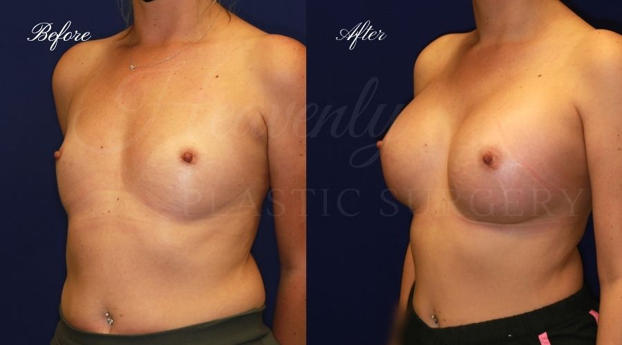 breast augmentation, breast augmentation surgery, breast augmentation surgeon, breast augmentation orange county, breast augmentation with silicone implants, sientra implants, boob job, boob job surgeon, breast implant surgeon, plastic surgery orange county, lake forest plastic surgeon, breast augmentation lake forest, south oc plastic surgeon