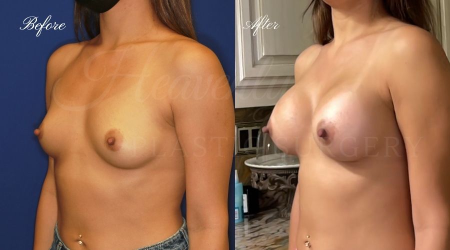 breast augmentation, breast augmentation surgery, breast augmentation surgeon, breast augmentation orange county, breast augmentation with silicone implants, sientra implants, boob job, boob job surgeon, breast implant surgeon, plastic surgery orange county, lake forest plastic surgeon, breast augmentation lake forest, south oc plastic surgeon breast augmentation, breast augmentation surgery, breast augmentation surgeon, breast augmentation orange county, breast augmentation with silicone implants, sientra implants, boob job, boob job surgeon, breast implant surgeon, plastic surgery orange county, lake forest plastic surgeon, breast augmentation lake forest, south oc plastic surgeon