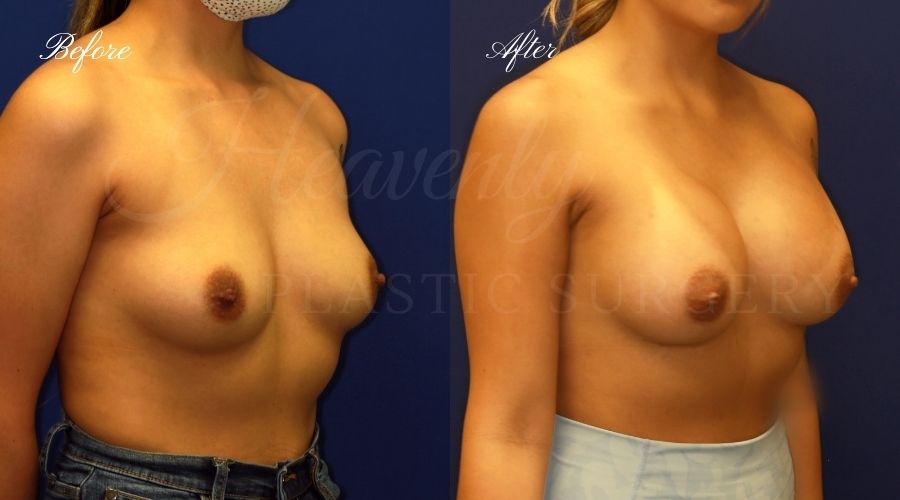 breast augmentation, breast augmentation surgery, breast augmentation surgeon, breast augmentation orange county, breast augmentation with silicone implants, sientra implants, boob job, boob job surgeon, breast implant surgeon, plastic surgery orange county, lake forest plastic surgeon, breast augmentation lake forest, south oc plastic surgeon