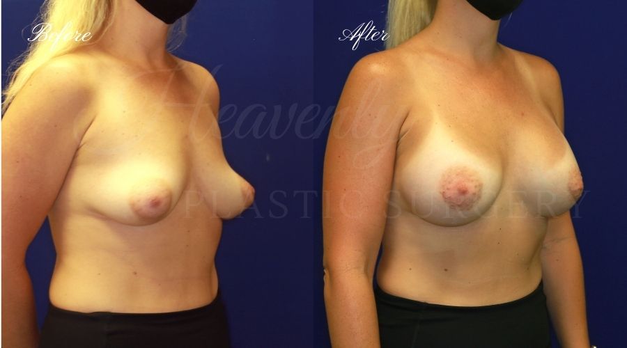 breast augmentation, breast augmentation surgery, breast augmentation surgeon, breast augmentation orange county, breast augmentation with silicone implants, sientra implants, boob job, boob job surgeon, breast implant surgeon, plastic surgery orange county, lake forest plastic surgeon, breast augmentation lake forest, south oc plastic surgeon breast augmentation, breast augmentation surgery, breast augmentation surgeon, breast augmentation orange county, breast augmentation with silicone implants, sientra implants, boob job, boob job surgeon, breast implant surgeon, plastic surgery orange county, lake forest plastic surgeon, breast augmentation lake forest, south oc plastic surgeon