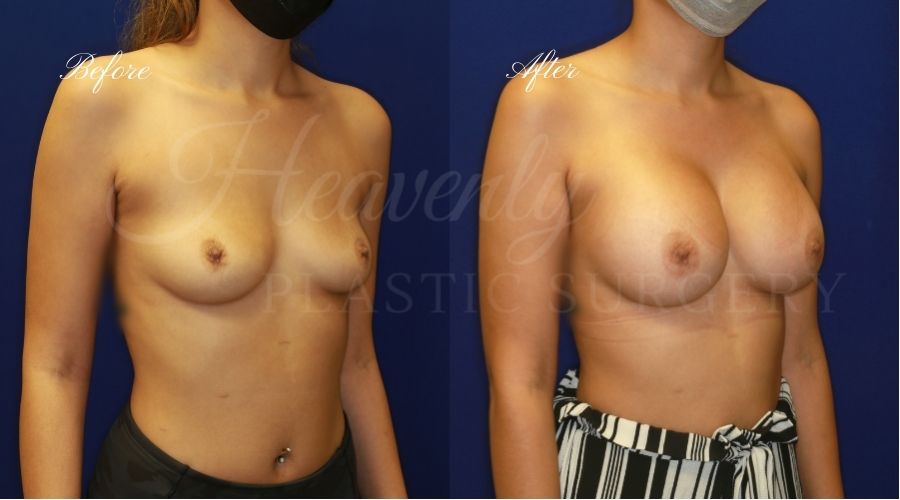 breast augmentation, breast augmentation surgery, breast augmentation surgeon, breast augmentation orange county, breast augmentation with silicone implants, sientra implants, boob job, boob job surgeon, breast implant surgeon, plastic surgery orange county, lake forest plastic surgeon, breast augmentation lake forest, south oc plastic surgeon